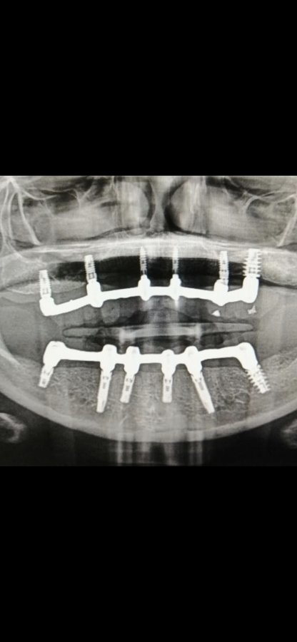 Live Implants Nicaragua - Live Implants Nicaragua