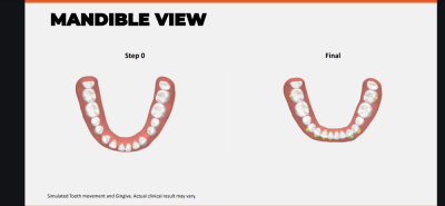 LuxCare Dental - Invisible Aligners