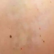 Lynn`s non-laser tattoo removal - Lynn`s non-laser tattoo removal