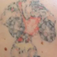 Lynn`s non-laser tattoo removal - Lynn`s non-laser tattoo removal