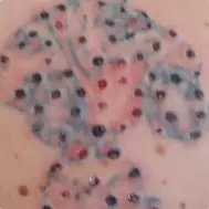 Lynn`s non-laser tattoo removal - Lynn`s non-laser tattoo removal