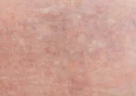 Lynn`s non-laser tattoo removal - Lynn`s non-laser tattoo removal