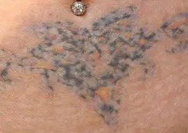 Lynn`s non-laser tattoo removal - Lynn`s non-laser tattoo removal