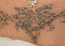 Lynn`s non-laser tattoo removal - Lynn`s non-laser tattoo removal