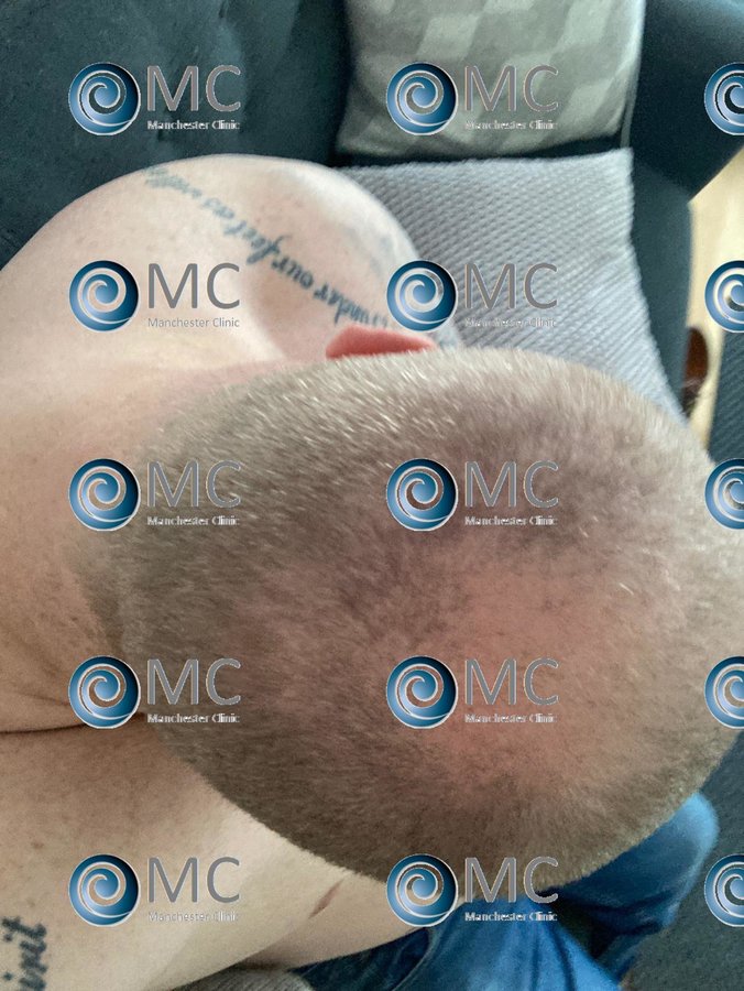 Manchester Hair Transplant Clinic - Manchester Hair Transplant Clinic