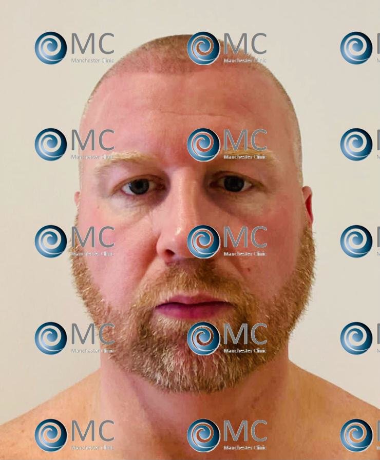 Manchester Hair Transplant Clinic - Manchester Hair Transplant Clinic