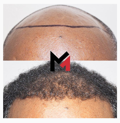 Maxim Hair Restoration Cebu - Maxim Hair Restoration Cebu