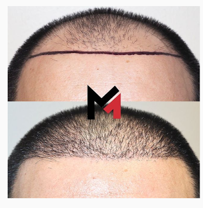 Maxim Hair Restoration Cebu - Maxim Hair Restoration Cebu