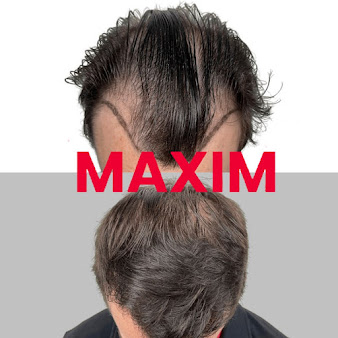 Maxim Hair Restoration Cebu - Maxim Hair Restoration Cebu