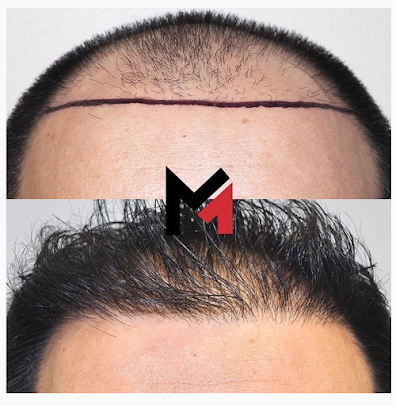 Maxim Hair Restoration Cebu - Maxim Hair Restoration Cebu