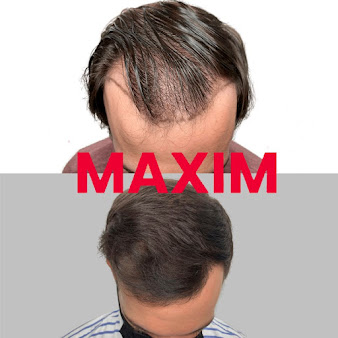 Maxim Hair Restoration Chicago - Maxim Hair Restoration Chicago