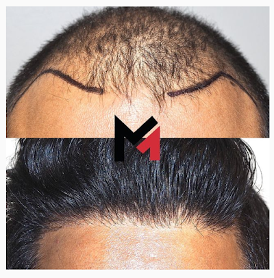 Maxim Hair Restoration Chicago - Maxim Hair Restoration Chicago