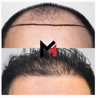 Maxim Hair Restoration Chicago - Maxim Hair Restoration Chicago