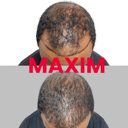 Maxim Hair Restoration Chicago - Maxim Hair Restoration Chicago