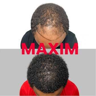 Maxim Hair Restoration Chicago - Maxim Hair Restoration Chicago