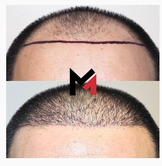Maxim Hair Restoration Chicago - Maxim Hair Restoration Chicago