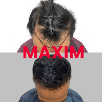 MAXIM Hair Restoration - New York City - MAXIM Hair Restoration - New York City