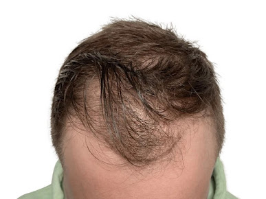 MAXIM Hair Restoration - New York City - MAXIM Hair Restoration - New York City