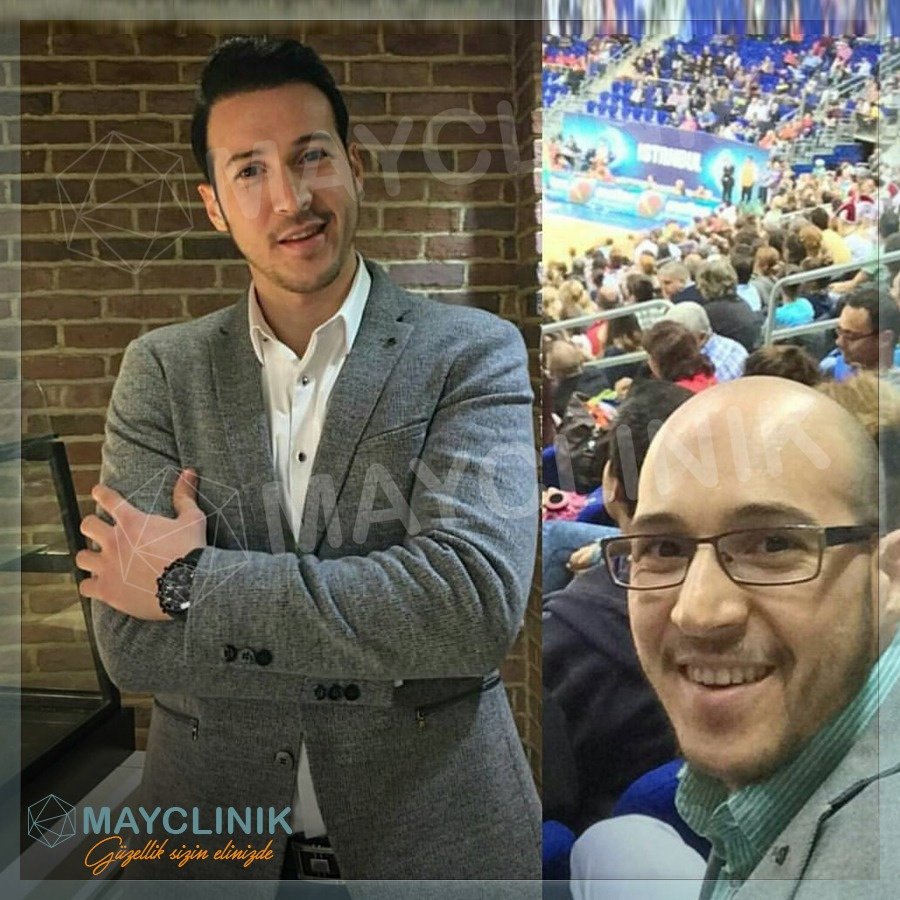 MayClinik Hair Transplant - MayClinik Hair Transplant