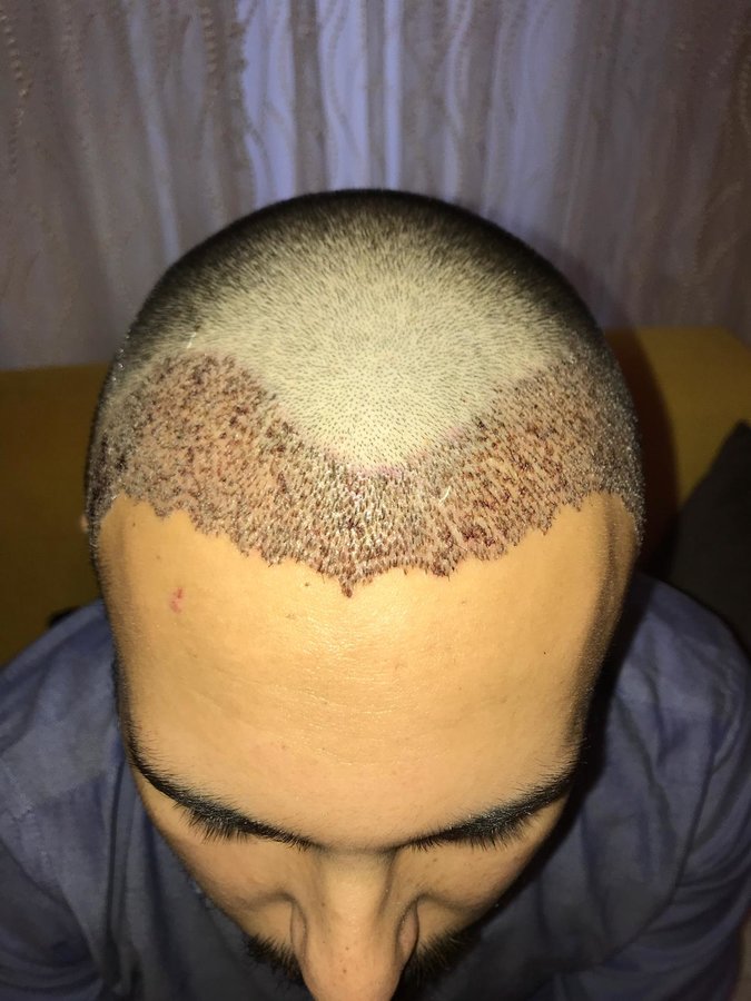 MayClinik Hair Transplant - MayClinik Hair Transplant