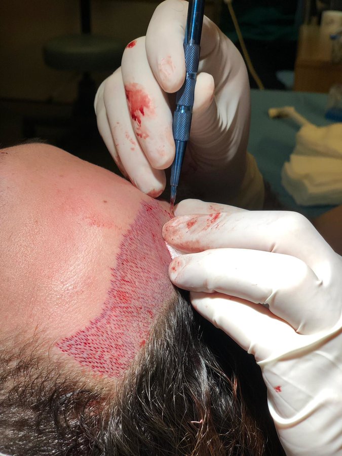 MayClinik Hair Transplant - MayClinik Hair Transplant