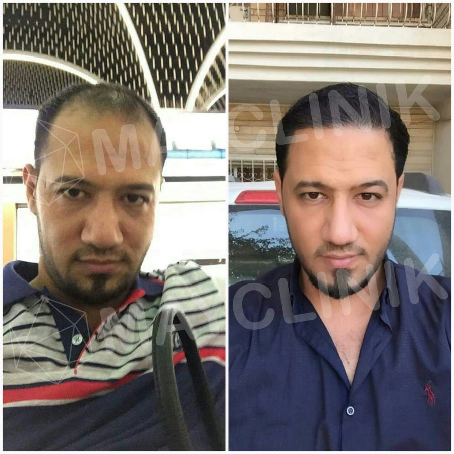 MayClinik Hair Transplant - MayClinik Hair Transplant