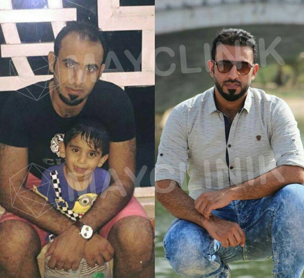 MayClinik Hair Transplant - MayClinik Hair Transplant