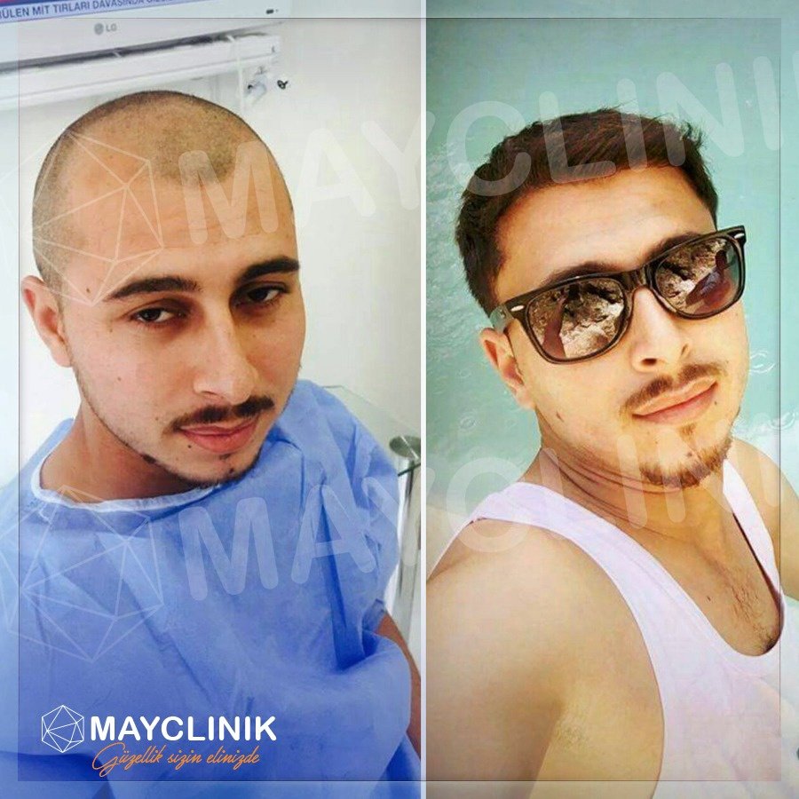 MayClinik Hair Transplant - MayClinik Hair Transplant