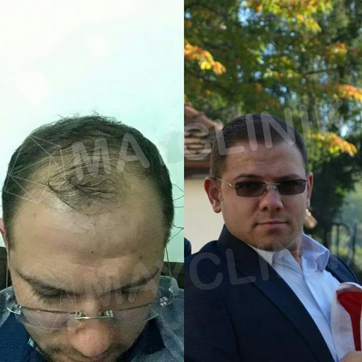 MayClinik Hair Transplant - MayClinik Hair Transplant