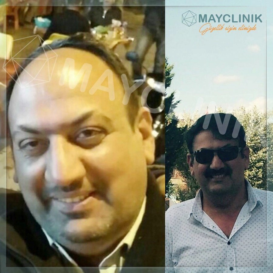 MayClinik Hair Transplant - MayClinik Hair Transplant