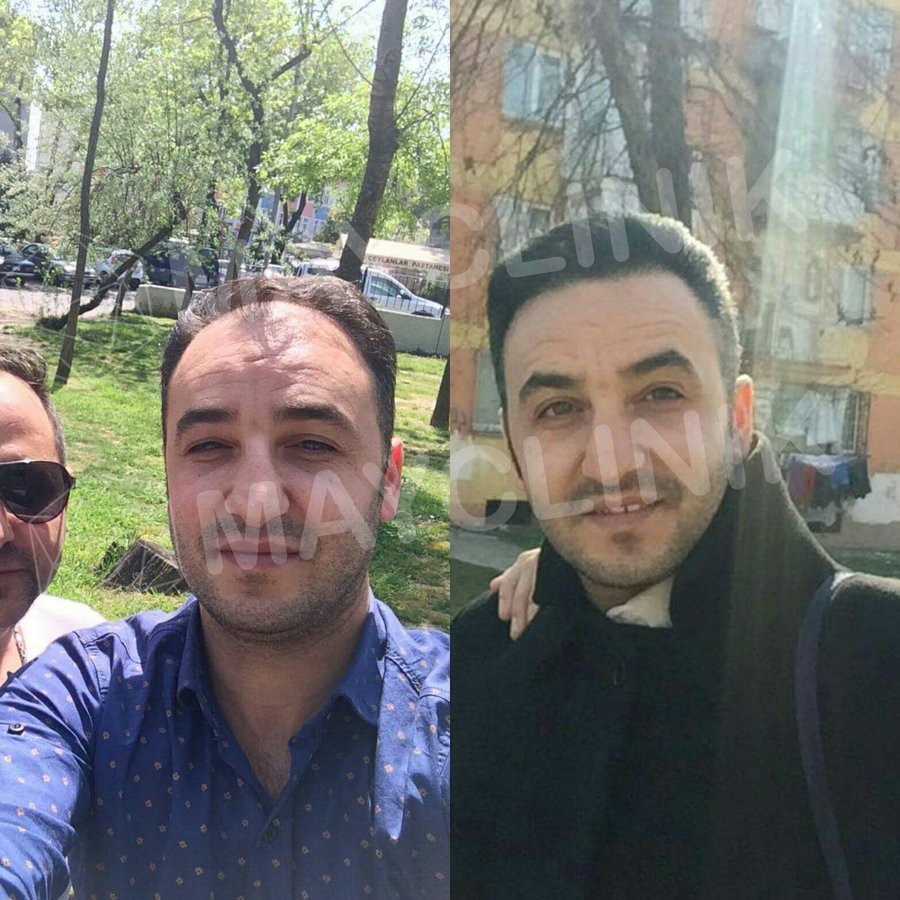 MayClinik Hair Transplant - MayClinik Hair Transplant