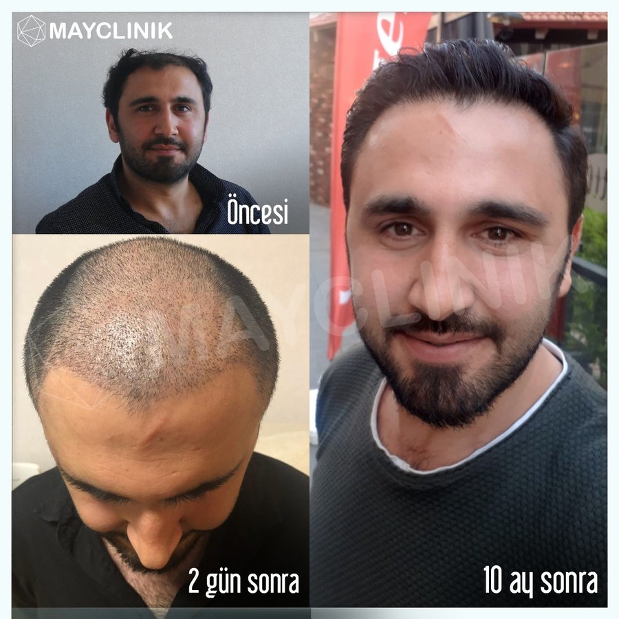 MayClinik Hair Transplant - MayClinik Hair Transplant