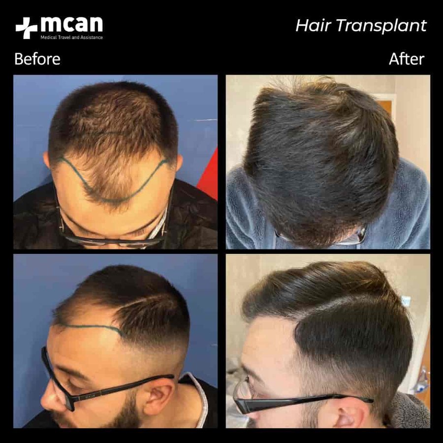 MCAN Health Hair Transplant - Kadikoy - MCAN Health Hair Transplant - Kadikoy
