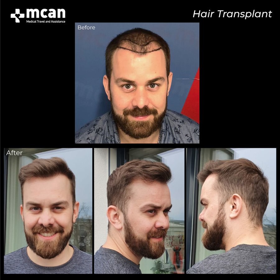 MCAN Health Hair Transplant - Kadikoy - MCAN Health Hair Transplant - Kadikoy