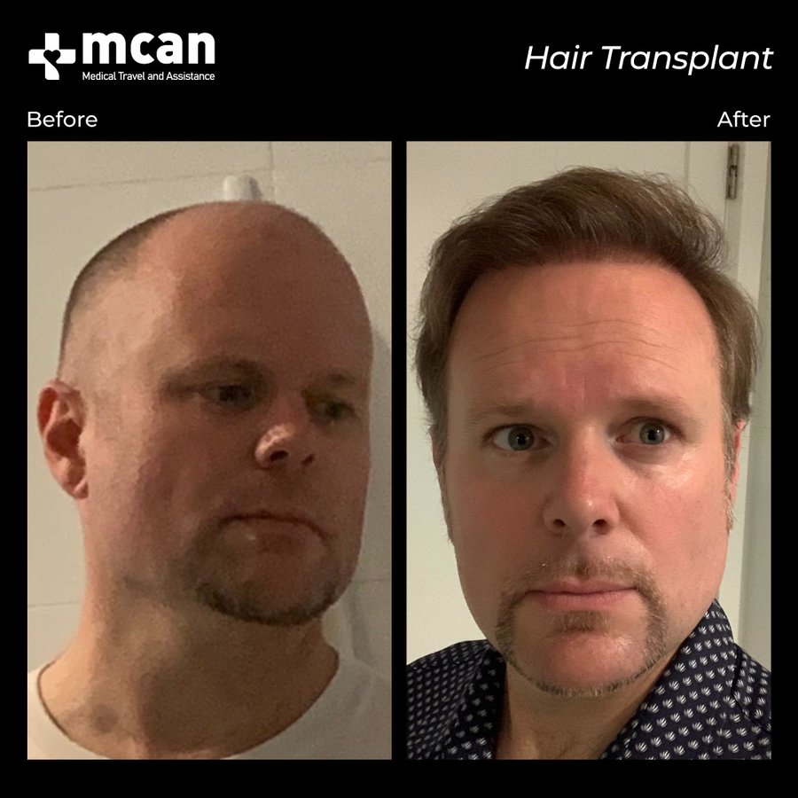 MCAN Health Hair Transplant - Kadikoy - MCAN Health Hair Transplant - Kadikoy