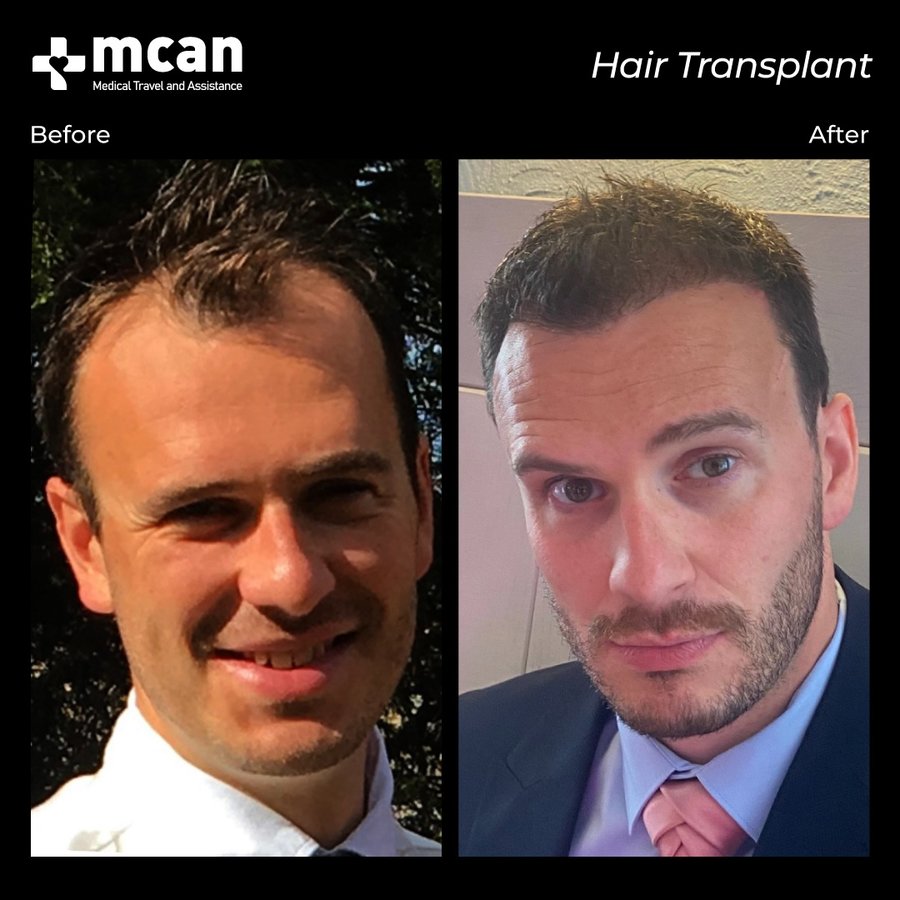 MCAN Health Hair Transplant - Kadikoy - MCAN Health Hair Transplant - Kadikoy