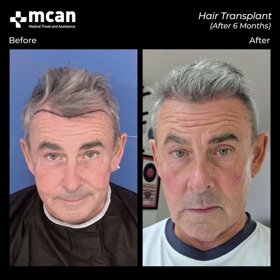 MCAN Health Hair Transplant - Kadikoy - MCAN Health Hair Transplant - Kadikoy