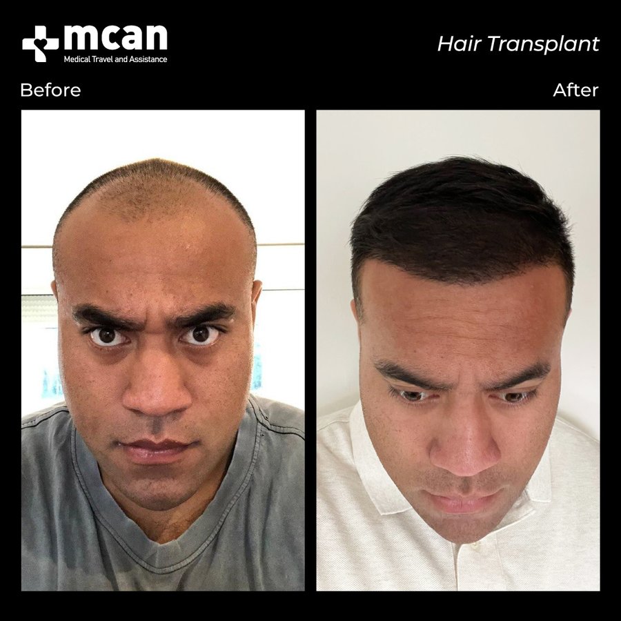 MCAN Health Hair Transplant - Kadikoy - MCAN Health Hair Transplant - Kadikoy