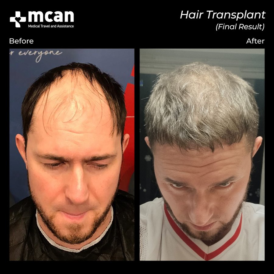 MCAN Health Hair Transplant - Kadikoy - MCAN Health Hair Transplant - Kadikoy