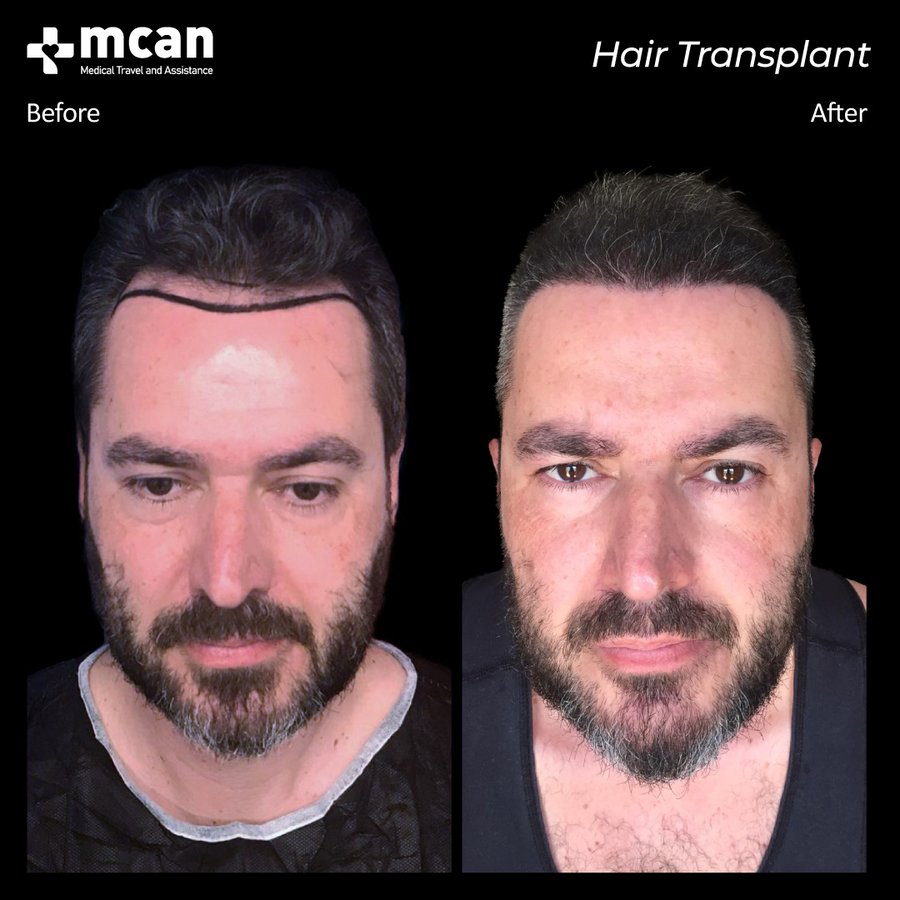 MCAN Health Hair Transplant - Kadikoy - MCAN Health Hair Transplant - Kadikoy