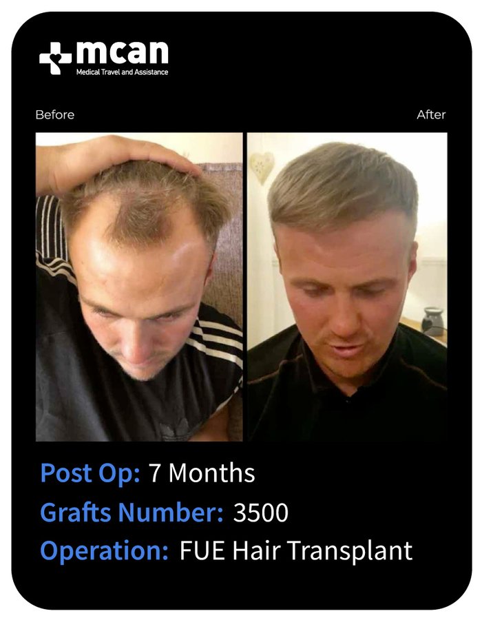 MCAN Health Hair Transplant - Kadikoy - MCAN Health Hair Transplant - Kadikoy