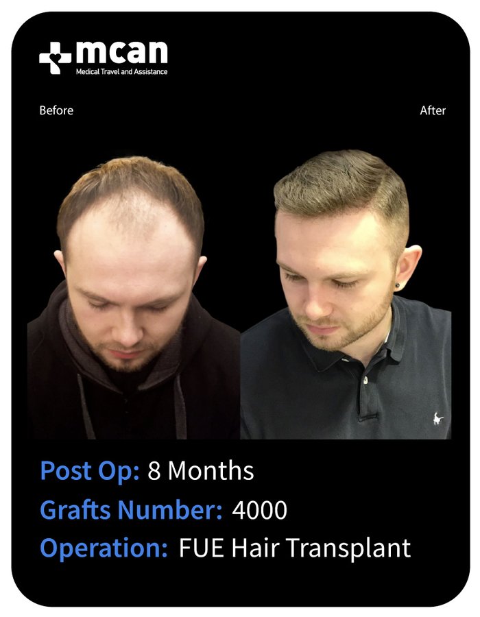 MCAN Health Hair Transplant - Kadikoy - MCAN Health Hair Transplant - Kadikoy