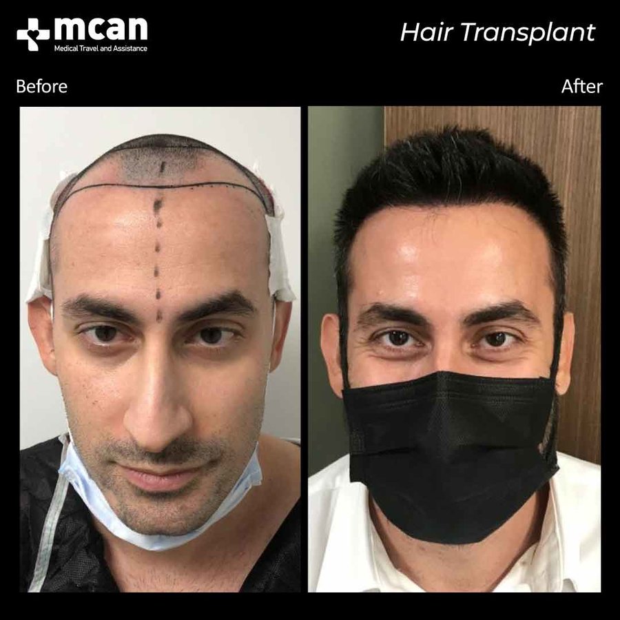 MCAN Health Hair Transplant - Kadikoy - MCAN Health Hair Transplant - Kadikoy