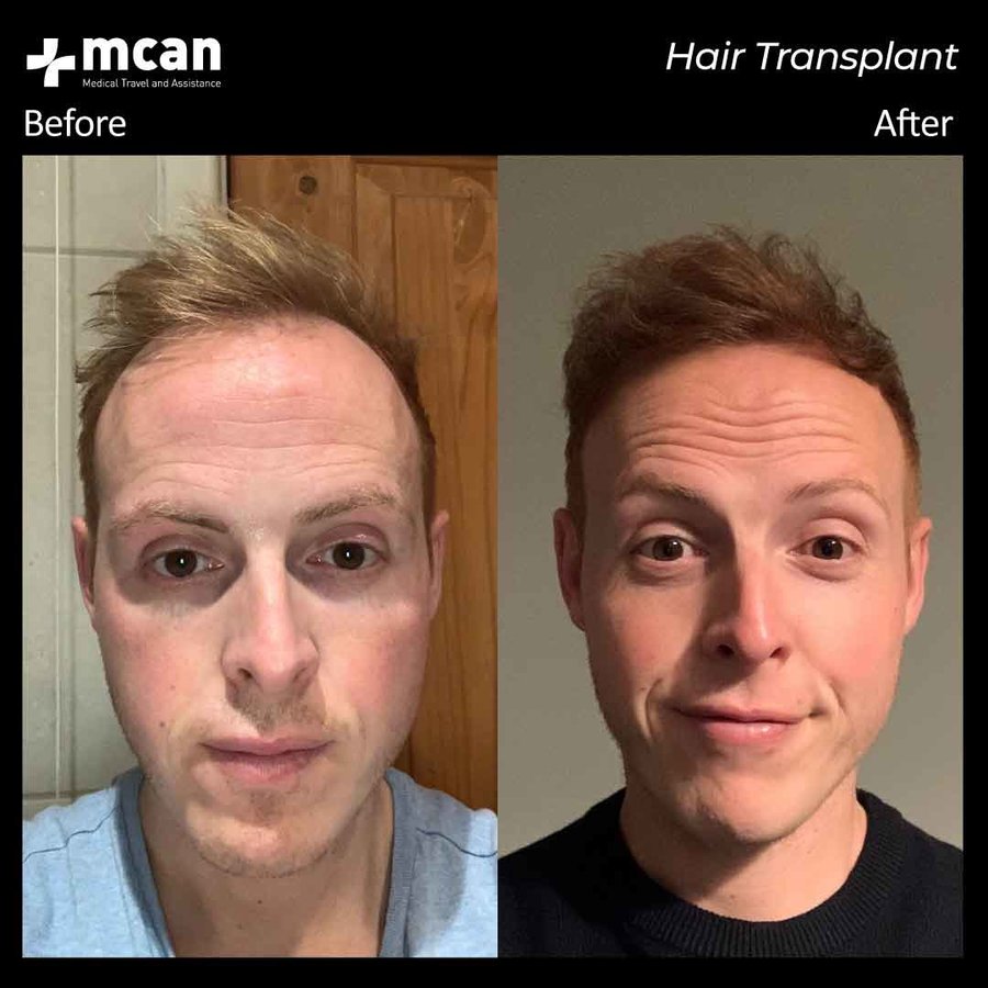 MCAN Health Hair Transplant - Kadikoy - MCAN Health Hair Transplant - Kadikoy