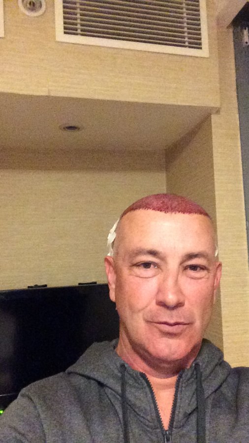MCAN Health Hair Transplant - Kadikoy - MCAN Health Hair Transplant - Kadikoy
