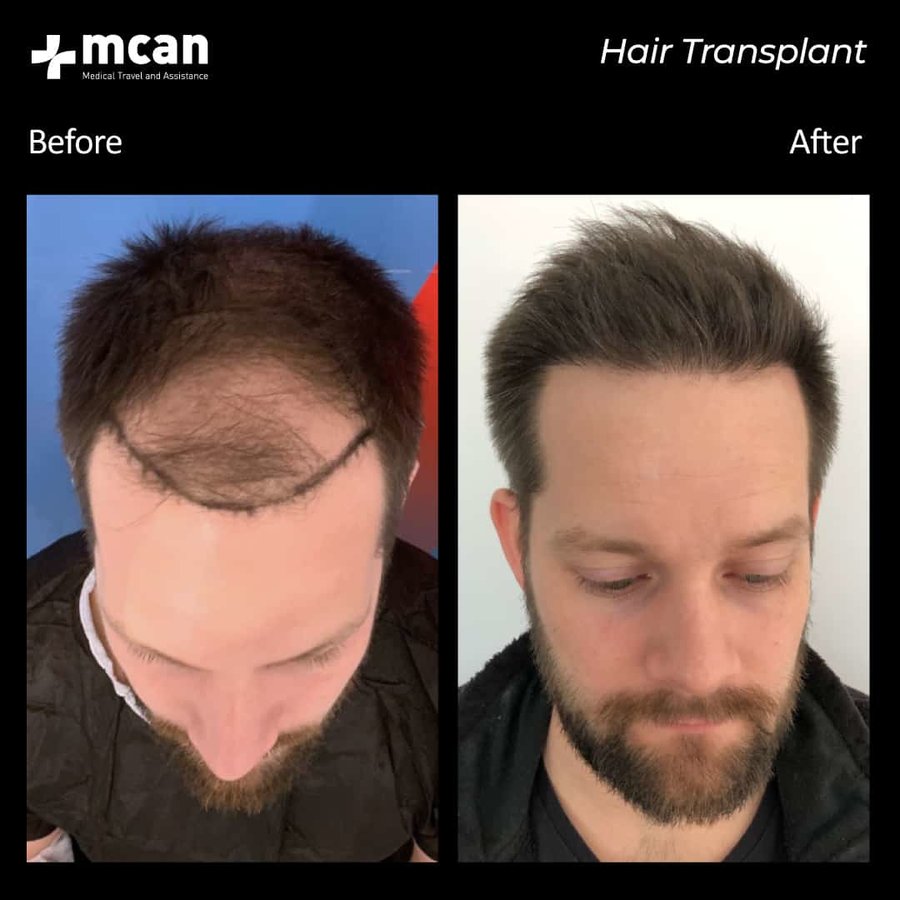 MCAN Health Hair Transplant - Kadikoy - MCAN Health Hair Transplant - Kadikoy