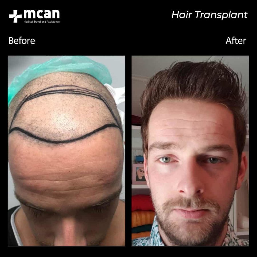 MCAN Health Hair Transplant - Kadikoy - MCAN Health Hair Transplant - Kadikoy