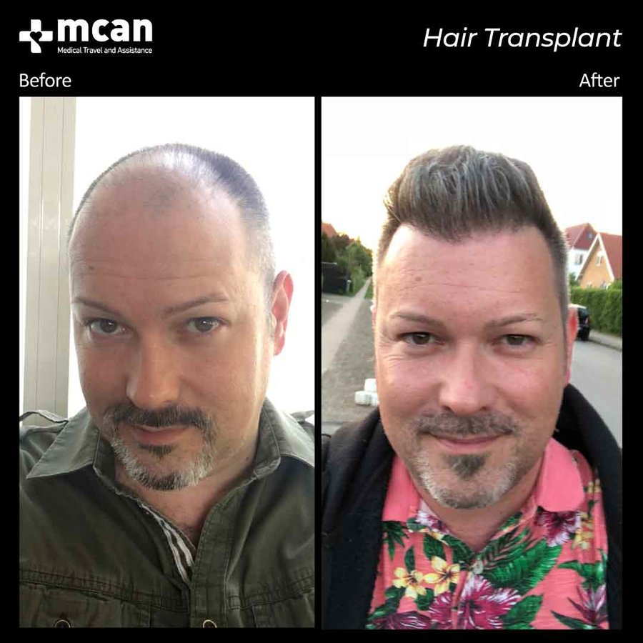 MCAN Health Hair Transplant - Kadikoy - MCAN Health Hair Transplant - Kadikoy