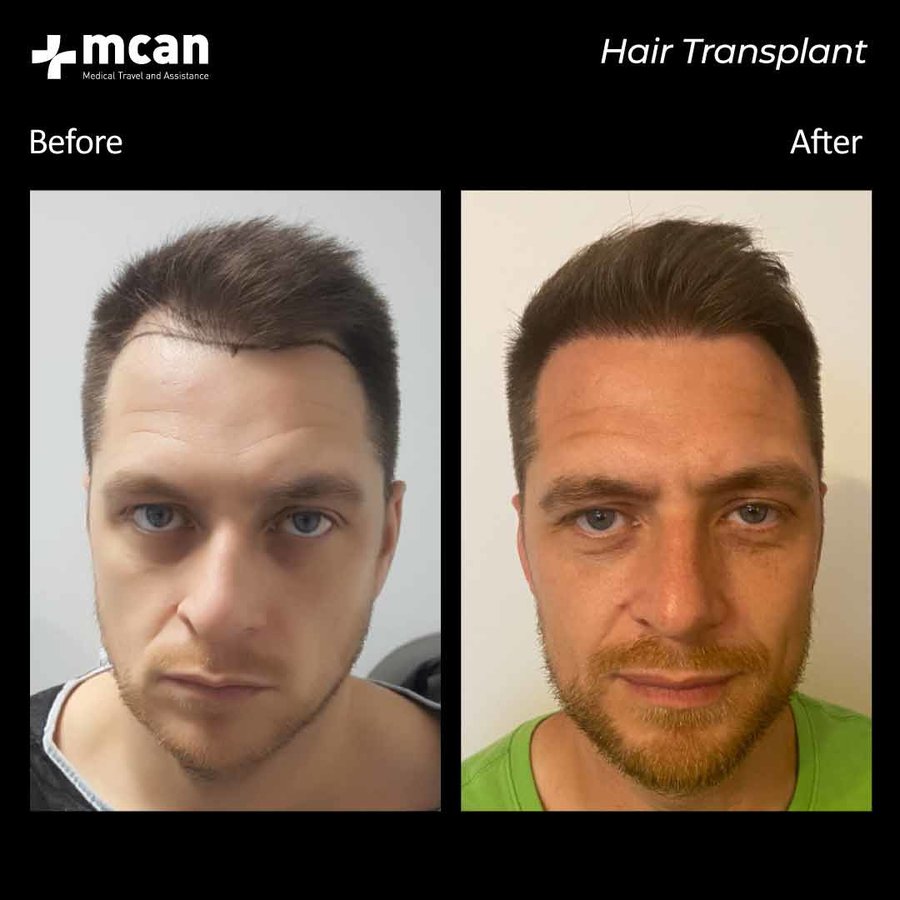 MCAN Health Hair Transplant - Kadikoy - MCAN Health Hair Transplant - Kadikoy