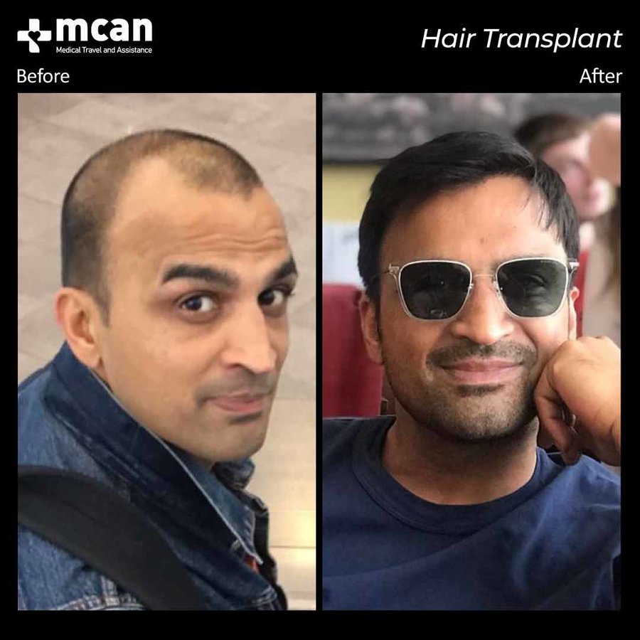 MCAN Health Hair Transplant - Kadikoy - MCAN Health Hair Transplant - Kadikoy